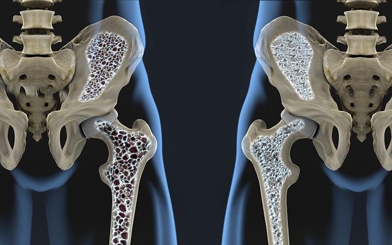 Hip Osteoporosis