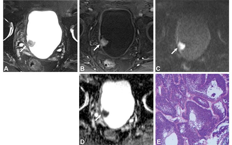 Wang Radiology Bladder Cancer Fig 3
