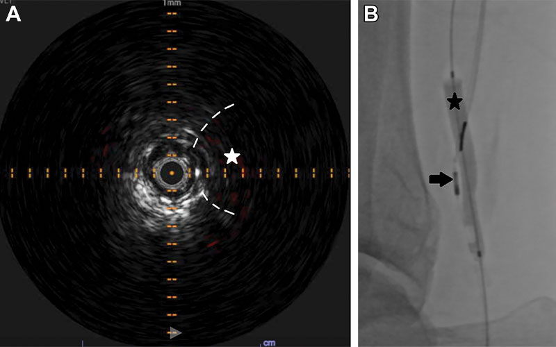 Intravascular Ultrasound Catheters | RSNA