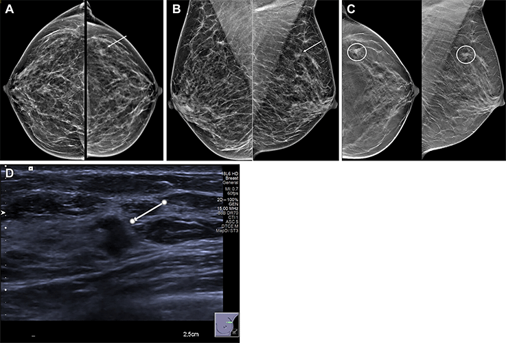 Ultrasound Effective at Diagnosing Localized Breast Lumps, Pain RSNA