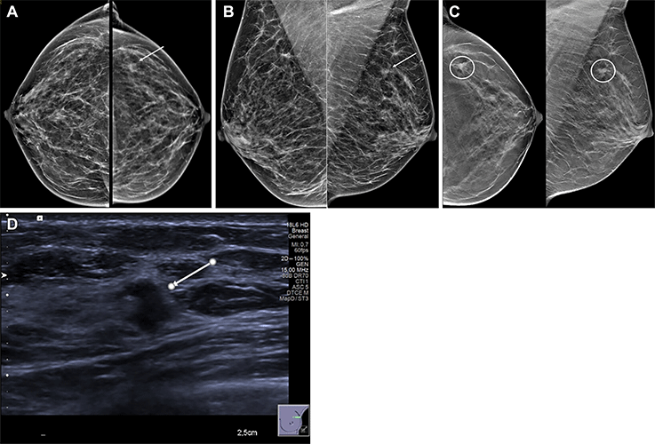 Appelman Radiology ultrasound for diagnosing breast lumps