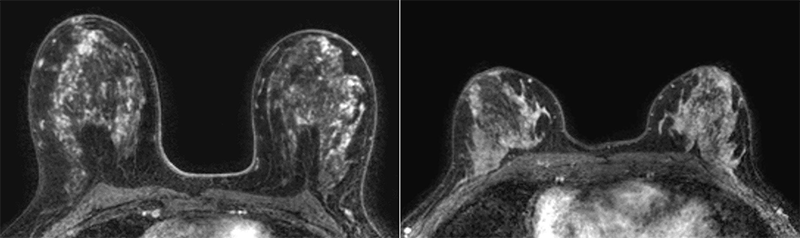 Gilhuijs Radiology Fig 4 breast MRI