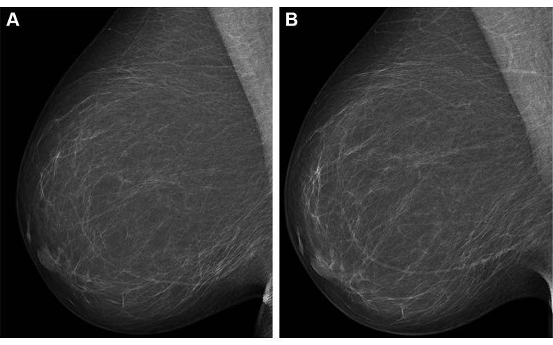 Lauritzen Radiology Breast AI Fig 4