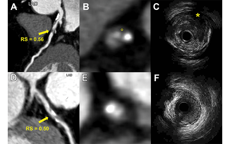Чжан Радиология КТ Сердечный приступ