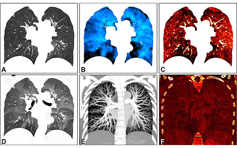 Shin Radiology Fig 2 photon counting CT to evaluate lung function