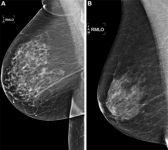Arasu Fig 3 RY AI Predicts Breast Cancer on Mammograms