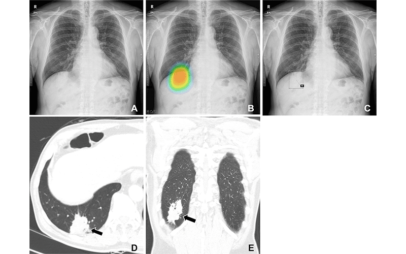 Park Radiology AI detection of lung nodules on X-ray