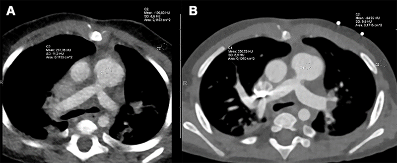 Dirrichs Radiology Fig 3 pediatric DSCT and PCCT Ventricular septum defect