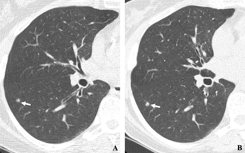 Henschke Radiology low-dose CT in lung cancer screening Fig 2