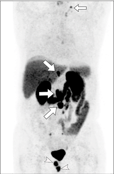 Awiwi RadioGraphics Prostate Cancer Using MRI and PSMA PET CT