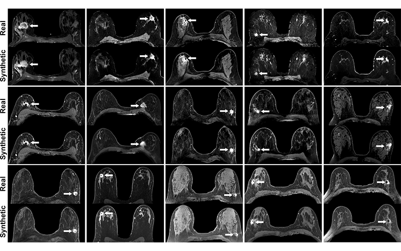 Simulated Contrast Enhanced Breast MRI RSNA