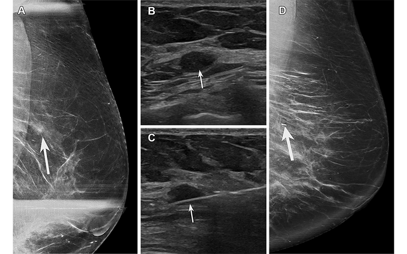 High Risk Breast Lesions | RSNA