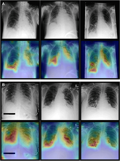 Хадер Р.Ю. Рис. 5 AI объединяет рентгенограмму грудной клетки с данными пациента