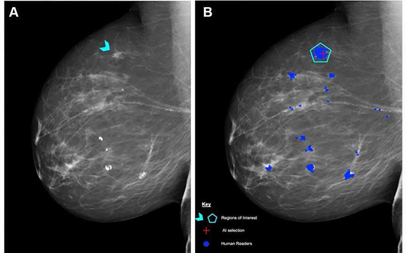 Chen RAD fig 2 breast ai mammography