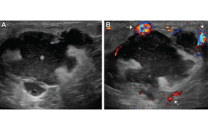 Pregnancy And Breastfeeding During Breast Imaging RSNA