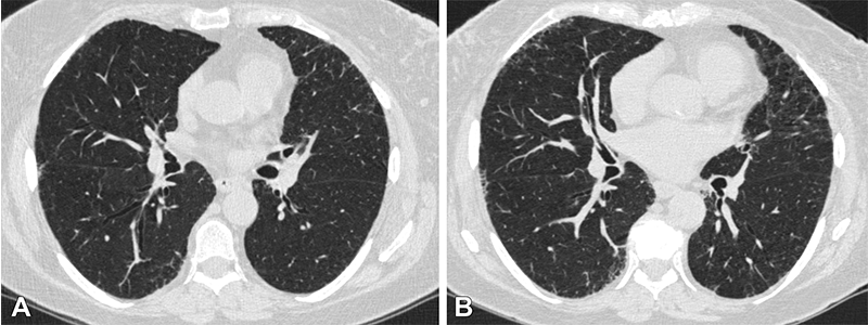 Choi Radiology Fig 2 Axial chest CT scans at (A) visit 1 and (B) visit 2 at the level of the takeoff of the right middle bronchus of a participant with 1.2 apq interstitial abnormality progression