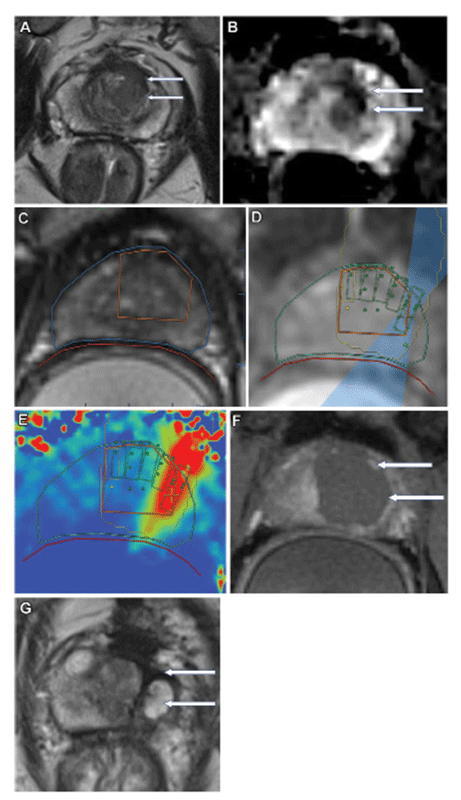 Ghai Radiology Fig 4 Images in a 56 -year-old man with biopsy-confirmed Gleason grade group 7 prostate cancer.