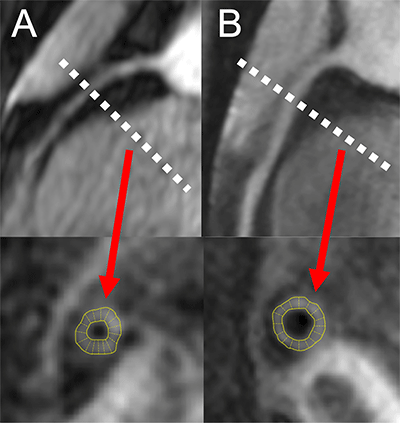 Hadigan Radiology Cardiothoracic Imaging Fig 2 MR angiograms of the right coronary arteries in two persons living with HIV and the corresponding automatic wall thickness measurement