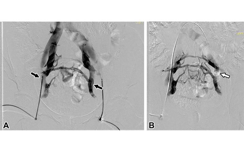 Bilateral IIV reflux in a 42-year-old woman (gravida 5, para 6) with a 12-year history of vulvar varicosities and chronic pelvic pain that progressed to the point where she could no longer exercise. (A) Catheter venographic image shows bilateral IIV reflux (arrows). The SVP classification was S2,3aV2,3a,3bPBIIV,R,NT. (B) Venographic image shows the bilateral IIV reflux treated with balloon occlusion embolization of the left iliac vein (arrow). The patient reported marked clinical improvement of her pelvic pain 3 months after embolization. https://doi.org/10.1148/rg.220039 ©RSNA 2023
