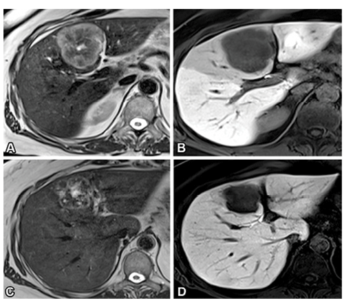 Castagnoli RadioGraphics Colorectal liver metastasis after stereotactic body radiation therapy in a 73-yearold patient