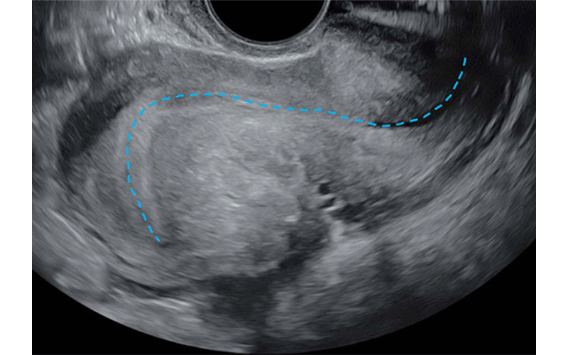 Young Radiology Fig 4 transvaginal ultrasound in a 41 year-old woman