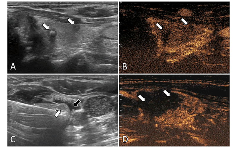Yu fig. 2 Radiology study. Ultrasound images in a 57 year-old female patient with multifocal papillary thyroid carcinoma.