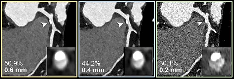 Emrich Radiology Fig. 4 coronary CT angiography for suspected progression of known CAD in a 56 year old female patient