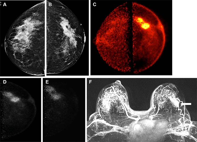 Fig 3 Freitas Imaging of 50 year old female patient with a new biopsy-proven malignant lesion in the left breast 
