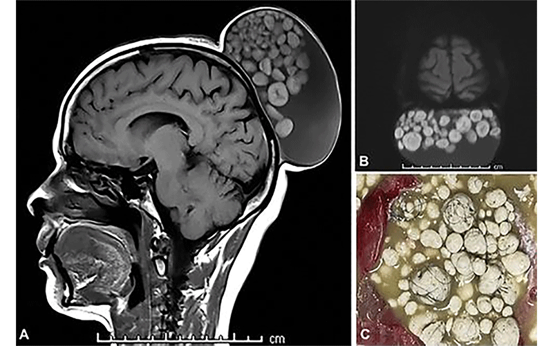 Images in a 52-year-old woman presenting with a scalp mass show a large cystic lesion in the subgaleal plane of the scalp with a “sack of marbles” appearance.
