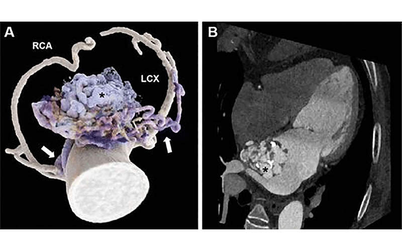 CT angiogram in a 64-yearold woman with a coronary artery left atrial fistula.