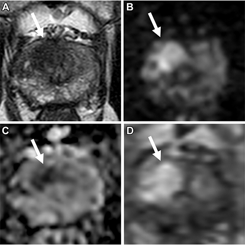 ultiparametric MRI in a 77-year-old man with an elevated prostate-specific antigen level of 10.7 ng/mL and a Prostate Imaging Reporting and Data System category 5 lesion located in the right apical-base anterior transition zone.