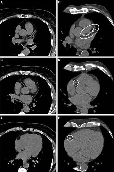 Dewey Fig 2 Radiology axial noncontrast CT scans in a participant with varying coronary artery calcium scores