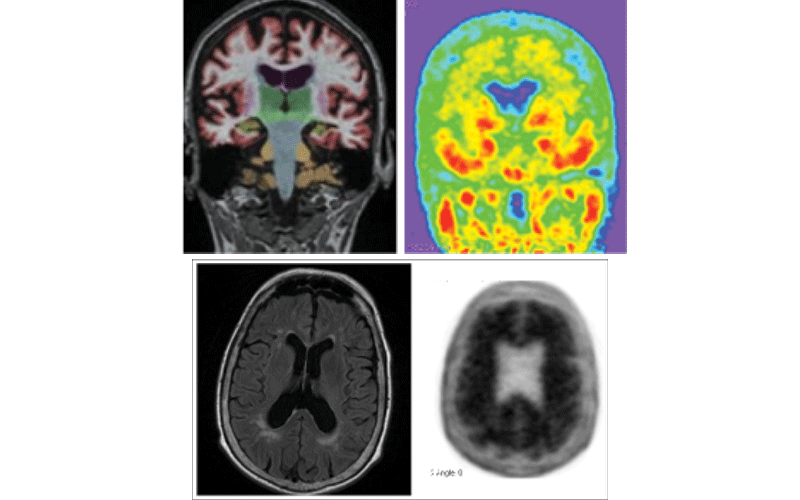PET MRI For Dementia Care | RSNA