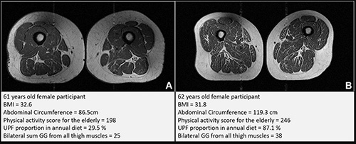 Representative axial T1-weighted spin-echo thigh MRI scans 