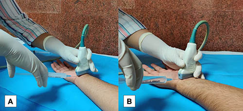Carpal Tunnel Syndrome Fig 1