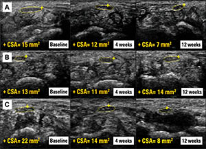 Carpal Tunnel Syndrome Fig 5