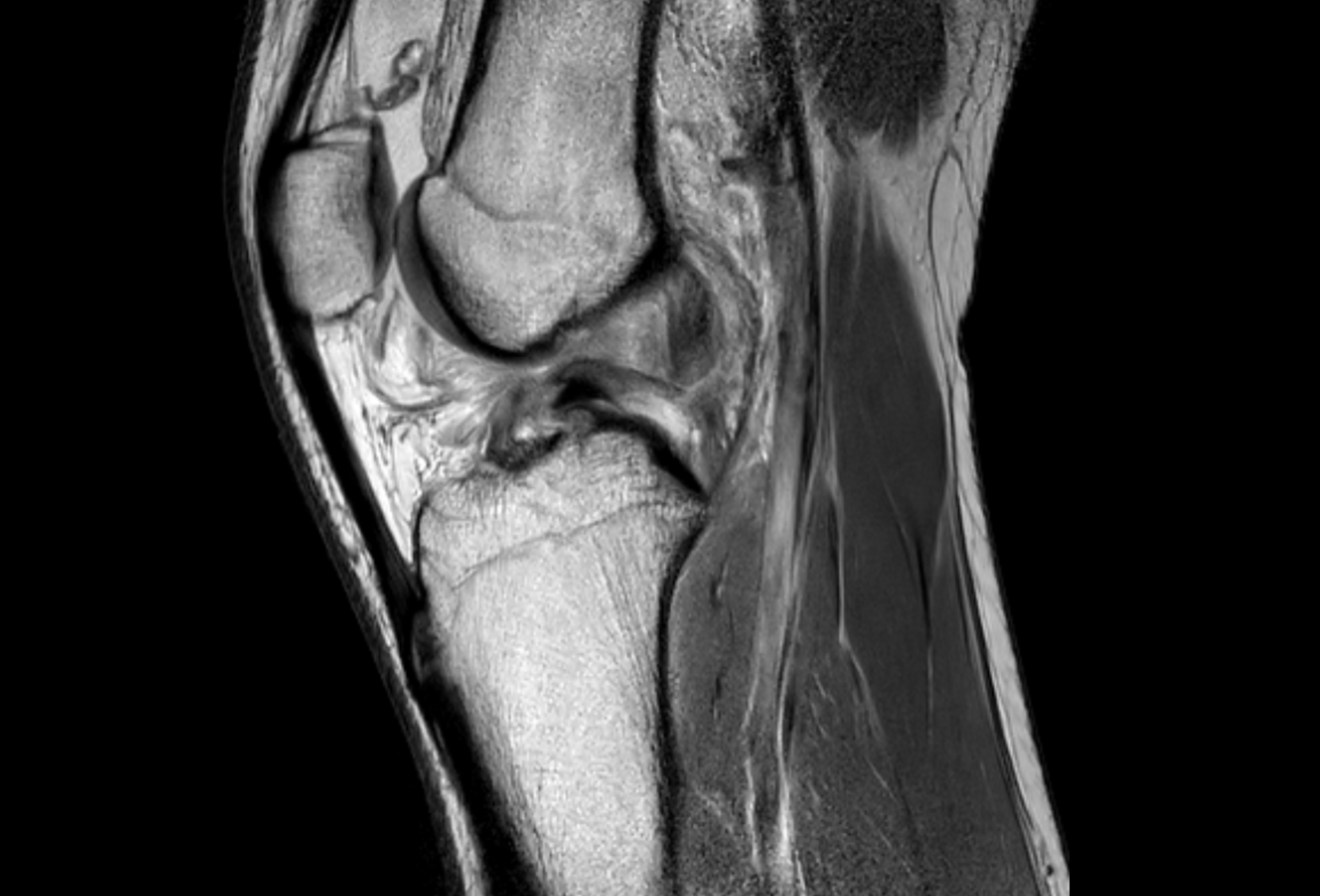 MRI knee