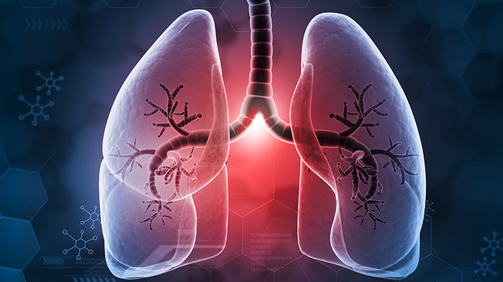 The Radiologists’ Role in Diagnosing Lung Toxicity from Anti-Cancer Drugs