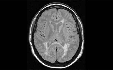 Multiple Sclerosis image