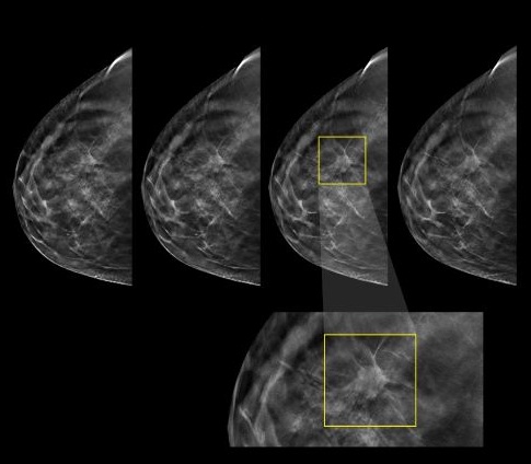 mammography-xray-cv