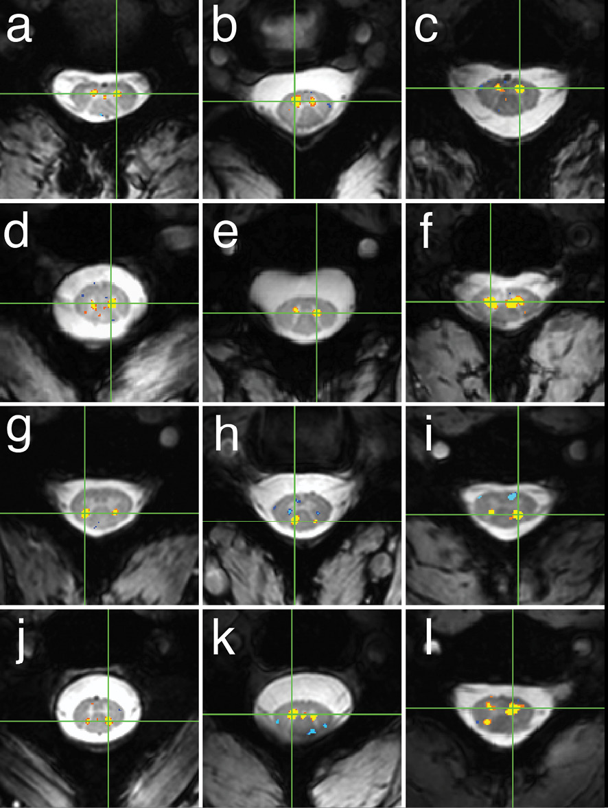Examples of within-slice resting state functional connectivity across subjects Examples of within-slice resting state functional connectivity across subjects