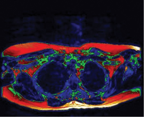 The first MR imaging study to show “brown fat” in a living adult The first MR imaging study to show “brown fat” in a living adult