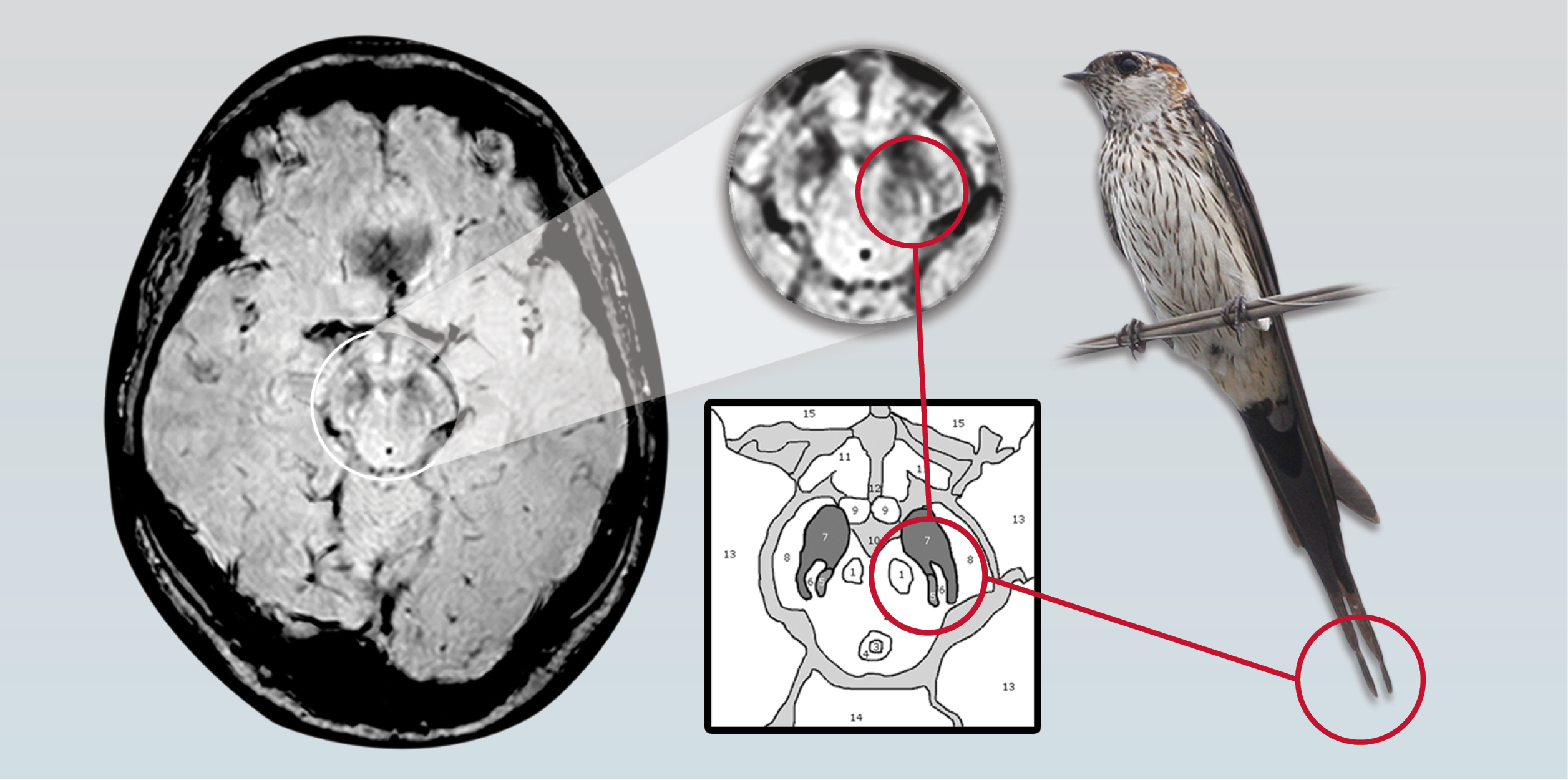 New research reveals that the split-tail shape, or “swallow tail,” (above, right) was clearly visible in normal patients but not present in patients with Parkinson disease. New research reveals that the split-tail shape, or “swallow tail,” (above, right) was clearly visible in normal patients but not present in patients with Parkinson disease.