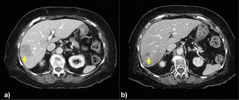 (a) Images of an 82-year-old woman with a solitary tumor in the right lobe measuring 4.5cm x 3.3 cm. (b) CT 5 months later demonstrated a reduction in bidimensional size to 1.3 cm x 1.3 cm after two right-lobar treatments at 93Gy subsequently followed by 119Gy. This patient had isolated liver metastases and remained free of extrahepatic disease 666 days after the first Y-90 treatment. (a) Images of an 82-year-old woman with a solitary tumor in the right lobe measuring 4.5cm x 3.3 cm. (b) CT 5 months later demonstrated a reduction in bidimensional size to 1.3 cm x 1.3 cm after two right-lobar treatments at 93Gy subsequently followed by 119Gy. This patient had isolated liver metastases and remained free of extrahepatic disease 666 days after the first Y-90 treatment.