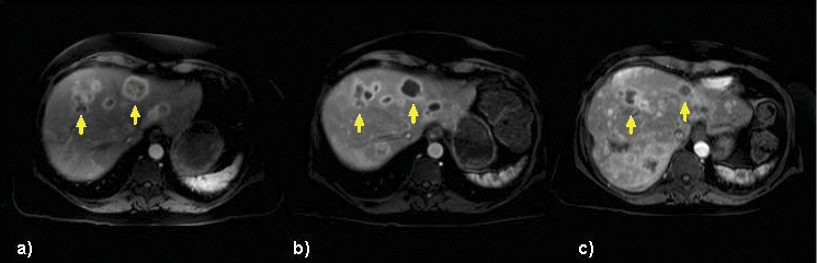 An image of a 55-year-old woman with (a) multiple tumors on MR imaging treated with selective right hepatic arterial catheterization and infusion of Y-90 followed by treatment of the left lobe 46 days later. Sequential bilobar treatment delivered 118Gy and 146Gy to the right- and left-lobe tumors targeted with Y-90, respectively. MR imaging demonstrated posttreatment changes at (b) 4 months and (c) 7 months imaging post right-lobe treatment and at (b) 3 months and (c) 6 months post left-lobe treatment confirming globally decreased multifocal bilobar disease burden. An image of a 55-year-old woman with (a) multiple tumors on MR imaging treated with selective right hepatic arterial catheterization and infusion of Y-90 followed by treatment of the left lobe 46 days later. Sequential bilobar treatment delivered 118Gy and 146Gy to the right- and left-lobe tumors targeted with Y-90, respectively. MR imaging demonstrated posttreatment changes at (b) 4 months and (c) 7 months imaging post right-lobe treatment and at (b) 3 months and (c) 6 months post left-lobe treatment confirming globally decreased multifocal bilobar disease burden.