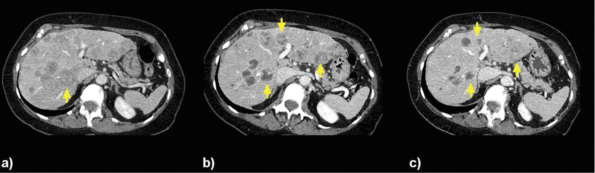 Images of a 76-year-old woman with (a) multiple liver lesions in both lobes treated with selective right hepatic arterial catheterization and infusion of Y-90 followed by treatment of the left lobe 35 days later. Treatment delivered localized radiation at 131Gy and 122Gy to the right- and left-lobe tumors targeted with Y-90, respectively; (b) CT demonstrates treatment changes at 1 month and (c) 2 months imaging post-right lobe treatment; and (c) 1 month post-left lobe treatment confirming globally decreased hepatic disease burden. This patient had stable bone metastases without extrahepatic disease progression for 111 days after the first Y-90 treatment. Images of a 76-year-old woman with (a) multiple liver lesions in both lobes treated with selective right hepatic arterial catheterization and infusion of Y-90 followed by treatment of the left lobe 35 days later. Treatment delivered localized radiation at 131Gy and 122Gy to the right- and left-lobe tumors targeted with Y-90, respectively; (b) CT demonstrates treatment changes at 1 month and (c) 2 months imaging post-right lobe treatment; and (c) 1 month post-left lobe treatment confirming globally decreased hepatic disease burden. This patient had stable bone metastases without extrahepatic disease progression for 111 days after the first Y-90 treatment.