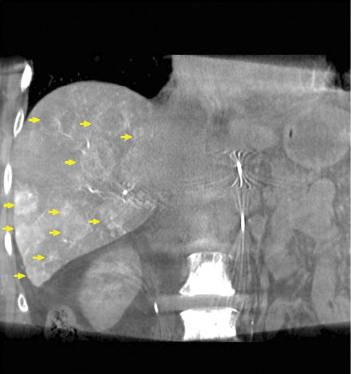 In the same patient, conebeam CT (coronal view) demonstrates selective visceral catheterization and angiography of hypervascular multifocal tumors perfused by the right hepatic artery. Large as well as small nodules recruited arterial perfusion and conebeam CT confirmed both catheter placement and preferential tumor perfusion over the normal hepatic tissues. In the same patient, conebeam CT (coronal view) demonstrates selective visceral catheterization and angiography of hypervascular multifocal tumors perfused by the right hepatic artery. Large as well as small nodules recruited arterial perfusion and conebeam CT confirmed both catheter placement and preferential tumor perfusion over the normal hepatic tissues.