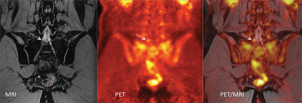 A coronal MRI A coronal MRI