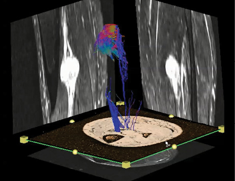 DTI of the tibial nerve at the lower leg in a patient with a benign peripheral nerve sheath tumor. DTI of the tibial nerve at the lower leg in a patient with a benign peripheral nerve sheath tumor.
