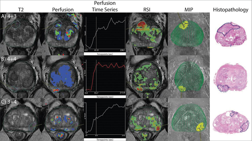Images from three patients who underwent targeted biopsy Images from three patients who underwent targeted biopsy